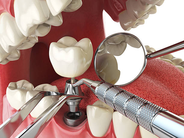 Best Emergency Dental Care for Abscessed Tooth in Lyons, OR